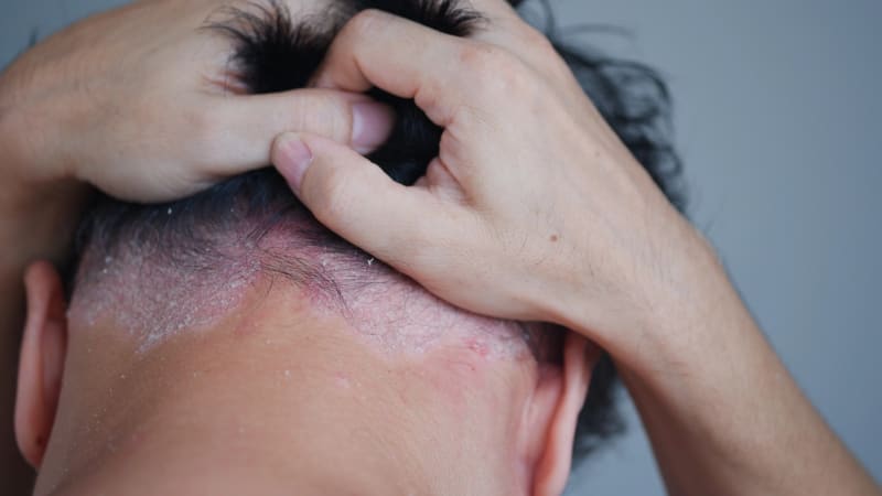 Krade sebevědomí a postihuje imunitu. Nepříjemnou lupénku řeší každý padesátý Čech