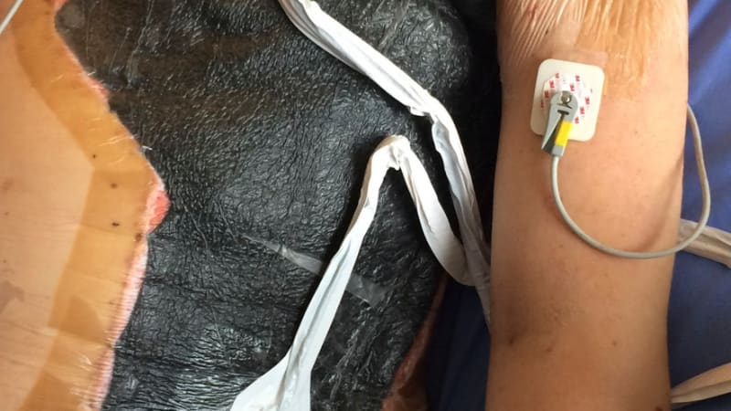 Masožravá bakterie ho málem připravila o život. Muž v Británii musel podstoupit 25 operací