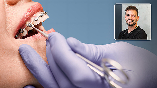 Epidemie rovnátek. Zájem o ně má stále víc dospělých, nosí je i psi, líčí zubař